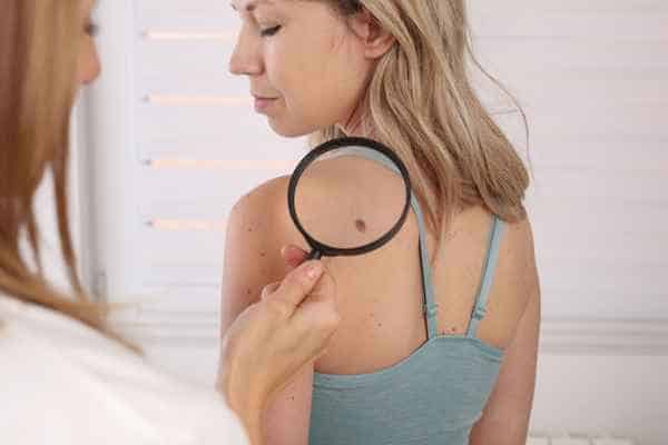 What Are Traditional Skin Lesion Removal Methods Bury?