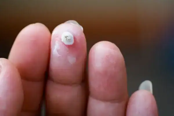 Image of white wart before cryopen treatment Bury