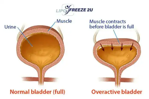 diagram of overactive bladder treatment Bury