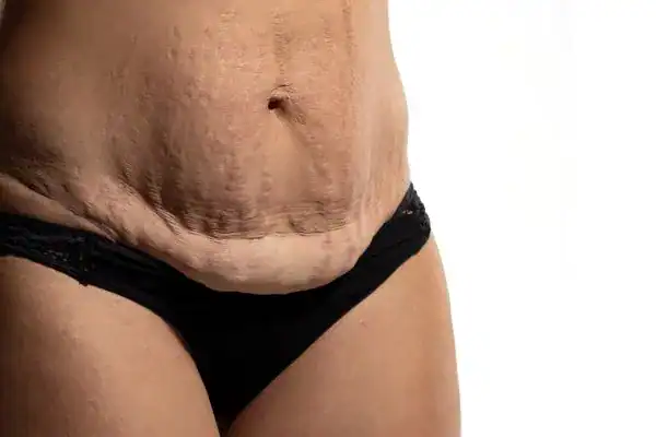 loose skin after weight loss injections Bury