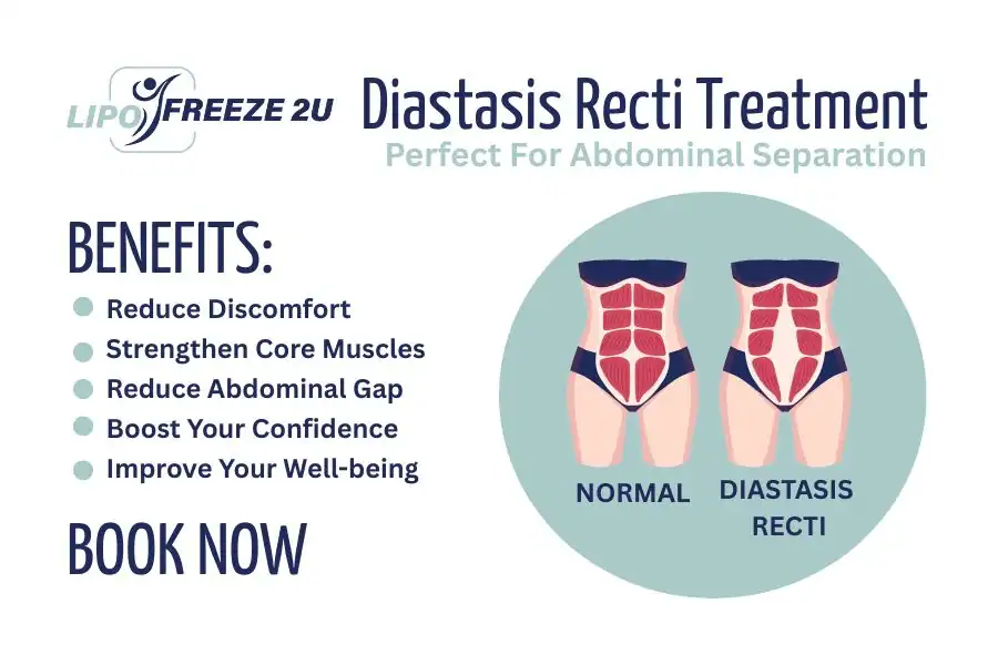 Benefits of body toning treatment Bury for Diastasis recti