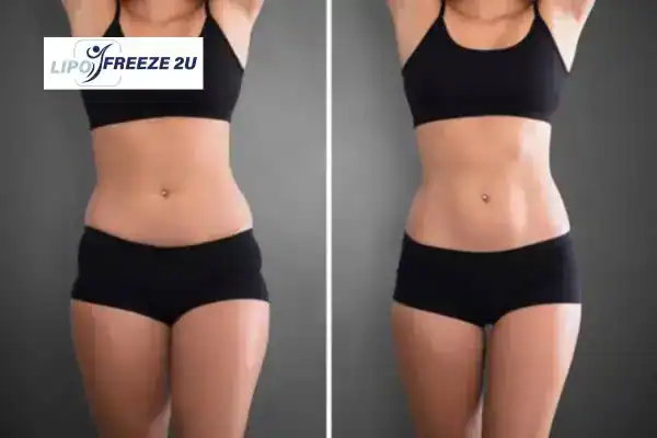 How Can LIPO FREEZE 2U Support Your Post-Pregnancy Body Recovery Bury?