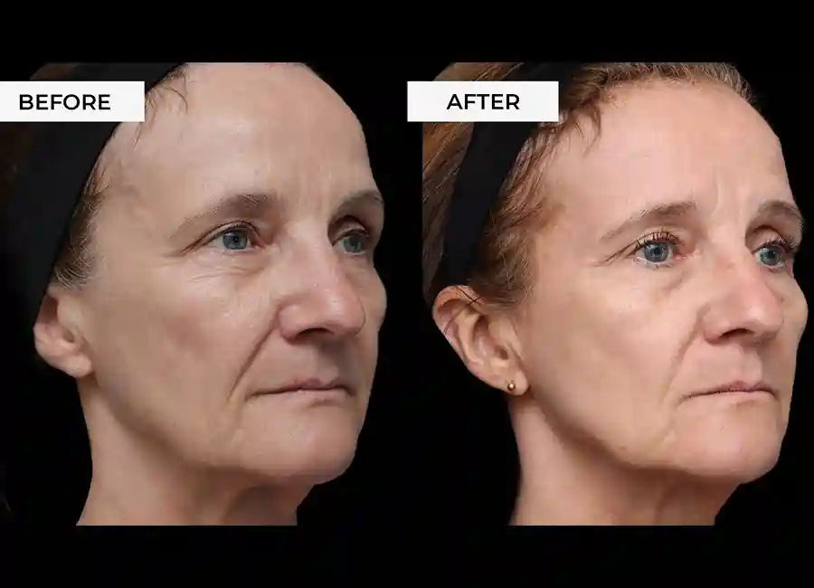 How Many RF Microneedling Sessions Will You Need to See a Difference Bury?